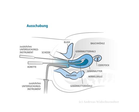 Schema einer Vakuumaspiration zur Entfernung des Schwangerschaftsgewebes