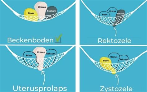 Illustration der verschiedenen Formen von Beckenorganprolaps: Zystozele, Rektozele, Enterozele und Uterusprolaps.
