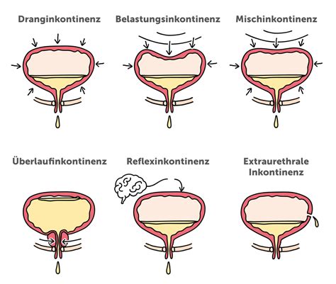 Infografik zur Unterscheidung der verschiedenen Inkontinenzformen und ihren Hauptbehandlungsmethoden.