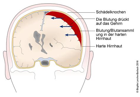 Illustration, die verschiedene Verletzungsarten bei einem Schütteltrauma zeigt: subdurales Hämatom, retinale Blutungen, Rippenfrakturen.