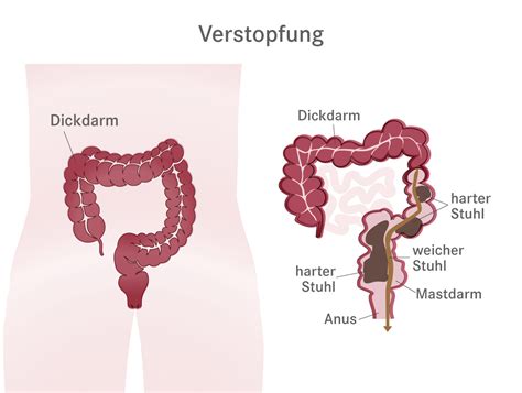 Schema, das die verschiedenen Ursachen von Verstopfung in der Stillzeit auflistet.