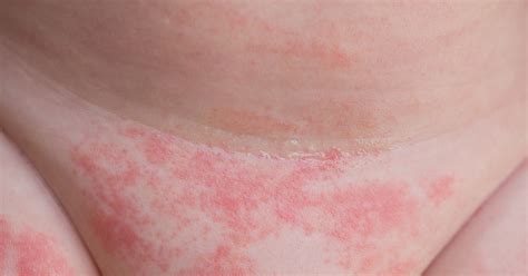 Illustration eines Babypopos mit Rötung und Entzündung, die typisch für eine Windeldermatitis ist.