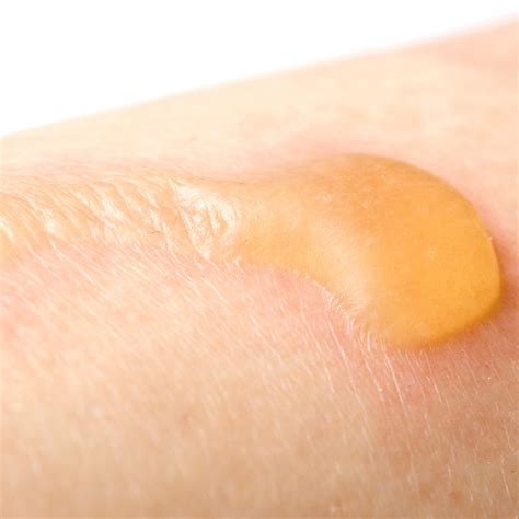 Nahaufnahme eines Babypopos mit deutlicher Rötung und gereizter Haut, die auf Windeldermatitis hindeutet.