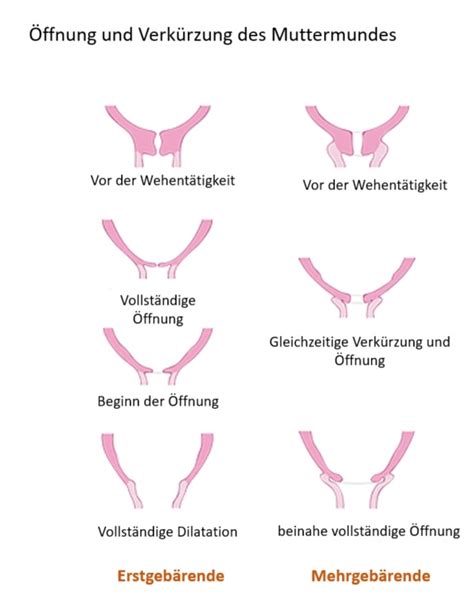 Illustration, die die Öffnung des Muttermundes während der verschiedenen Geburtsphasen zeigt.