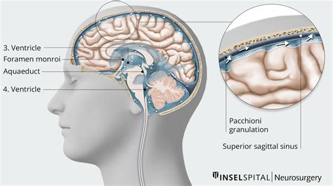 Schema des kindlichen Gehirns mit Darstellung eines Hydrocephalus
