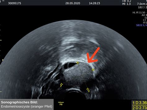 Ultraschallbild eines Eierstocks mit Follikeln