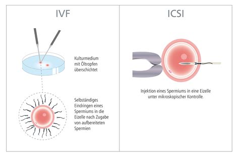 Schematische Darstellung der In-Vitro-Fertilisation (IVF) und ICSI.