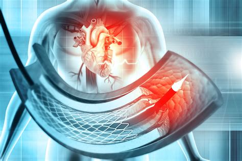 Illustration eines winzigen Herzkatheter-Implantats