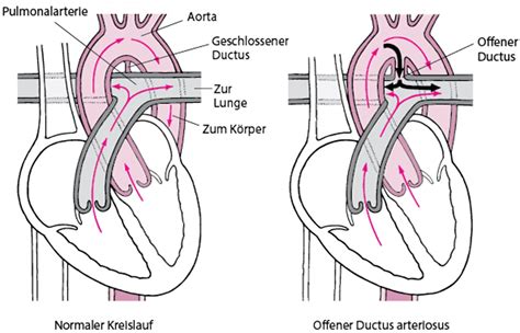 Schema, das den Blutfluss bei einem offenen Ductus arteriosus darstellt