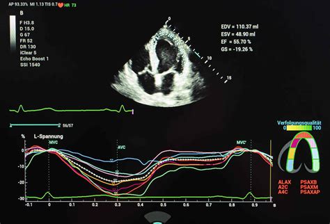 Ultraschallgerät zur fetalen Echokardiographie