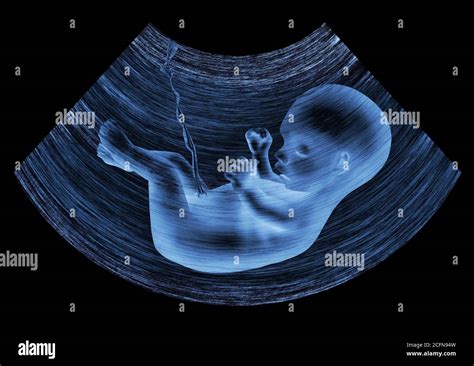 Ultraschallbild eines Fötus im Mutterleib mit Hinweis auf mögliche Makrosomie