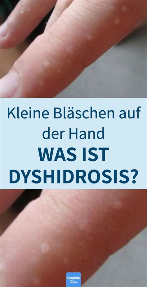 Infografik mit verschiedenen Faktoren, die das dyshidrotische Ekzem begünstigen können.