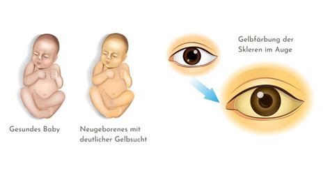 Collage aus anonymisierten Zitaten von Eltern, die ihre Erfahrungen mit Neugeborenen-Gelbsucht in China teilen.
