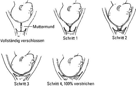 Infografik, die den Ablauf der Muttermundöffnung während der Geburt veranschaulicht.