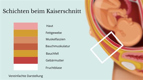 Infografik, die die verschiedenen Schichten der Bauchdecke und Gebärmutter zeigt, die bei einem Kaiserschnitt durchtrennt und vernäht werden.
