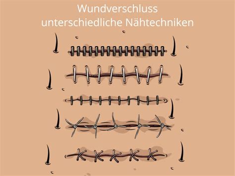 Diagramm, das den Unterschied zwischen älteren und neueren Nahttechniken bei Kaiserschnitten zeigt und die Entstehung von Defekten verdeutlicht.