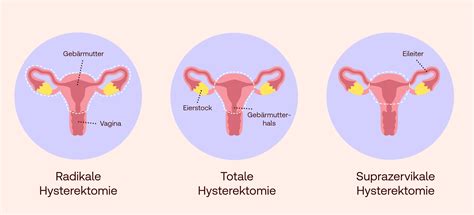Darstellung der Zellschichten des Gebärmutterhalses