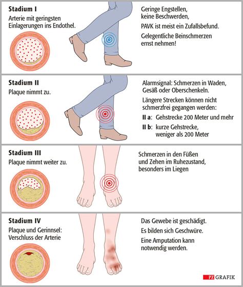 Schema zur Lokalisation von Wachstumsschmerzen in den Beinen.