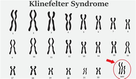 Beispiel eines Karyogramms bei Klinefelter-Syndrom