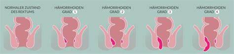 Vergleichstabelle: Analvenenthrombose vs. Hämorrhoiden