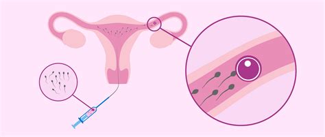 Grafik, die den Prozess der IUI veranschaulicht: Follikelwachstum, Auslösen des Eisprungs, Spermaaufbereitung und intrauterine Insemination