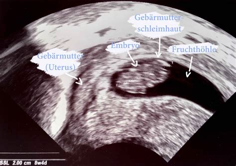 Embryo mit schlagendem Herzen im Ultraschall
