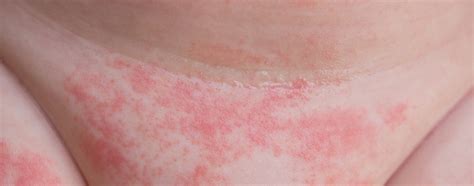 Nahaufnahme einer typischen Windeldermatitis mit deutlicher Rötung und Aufweichung der Haut.