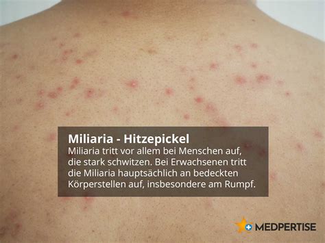 Schema, das die typischen Stellen für Neugeborenenakne und Hitzepickel bei Babys zeigt.