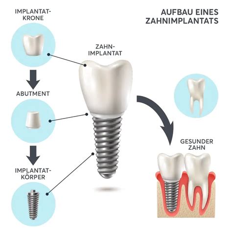 Illustration verschiedener Arten von Zahnersatz: Krone, Brücke, Implantat und Prothese