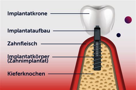 Schema eines zahnärztlichen Implantats mit Aufbau und Krone