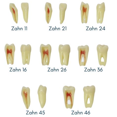 Grafik, die die verschiedenen Grade der Hypodontie von einzelnen Zähnen bis zu ganzen Zahngruppen zeigt