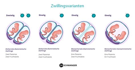 Schema der Blutgefäßverbindungen in der Plazenta bei einer monochorialen Zwillingsschwangerschaft mit Fetofetalem Transfusionssyndrom