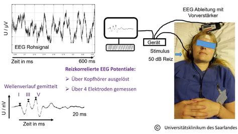 Schematische Darstellung der Hirnstammaudiometrie (BERA)