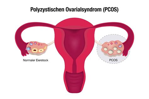 Grafik mit empfohlenen Lebensmitteln bei PCOS