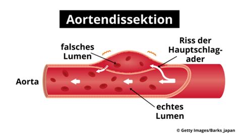 Illustration einer Aortendissektion mit Riss in der Hauptschlagader