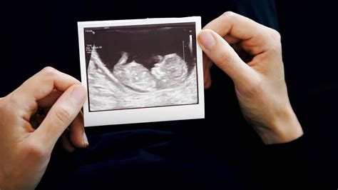 Grafik zur Veranschaulichung des Hormonrückgangs nach einer Fehlgeburt