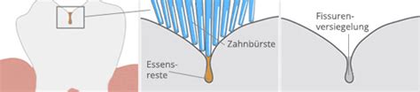 Schema einer Fissurenversiegelung an einem Backenzahn