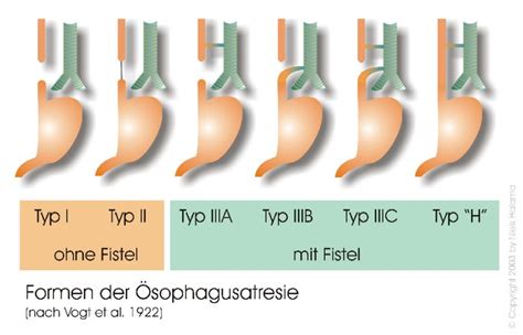 Schema der verschiedenen Typen der Ösophagusatresie nach Vogt