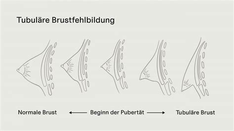 Schema zur Erklärung des Blockstillens: Zeitblöcke für das Stillen an einer Brust, mit Pausen für die andere Brust.