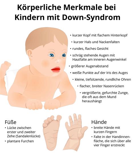 Beispiele für die typischen körperlichen Merkmale von Neugeborenen mit Down-Syndrom