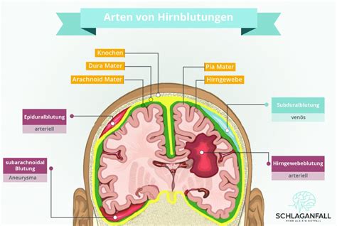 Schema der verschiedenen Grade von Hirnblutungen bei Frühgeborenen
