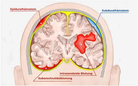 Vergleich der Entwicklung von Frühgeborenen mit und ohne Hirnblutung