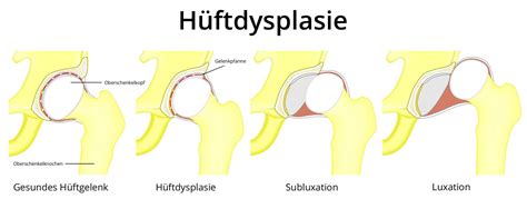 Schema der Hüftgelenksdysplasie mit Darstellung der unterschiedlichen Schweregrade