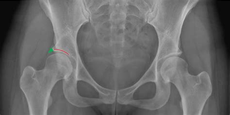 Beispiel für eine Röntgenaufnahme des Hüftgelenks zur Diagnose von Hüftdysplasie