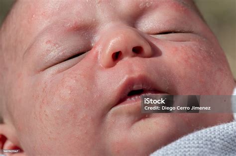 Schema des Gesichts eines Babys mit typischen Stellen für Neugeborenenakne (Wangen, Stirn, Kinn)