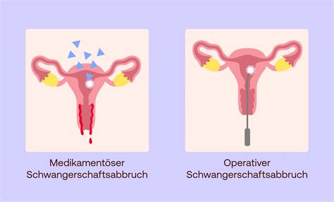 Schema der beiden Methoden des Schwangerschaftsabbruchs: medikamentös und operativ