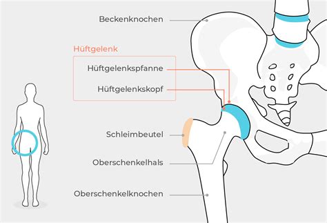 Schema des menschlichen Hüftgelenks mit Darstellung der Hüftpfanne und des Hüftkopfes.