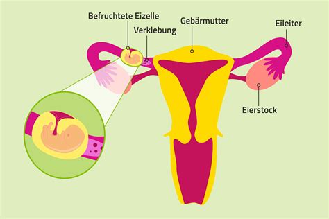 Schema einer Bauchspiegelung zur Entfernung einer Eileiterschwangerschaft