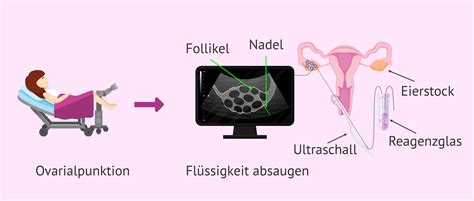 Illustration einer Follikelpunktion unter Ultraschallkontrolle