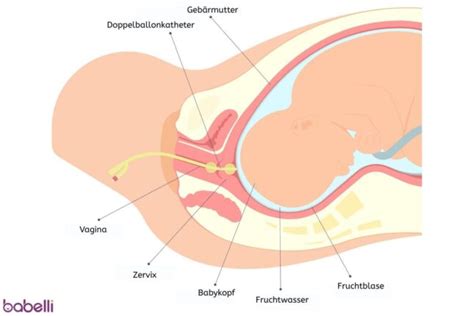 Schema eines Ballonkatheters zur Geburtseinleitung.